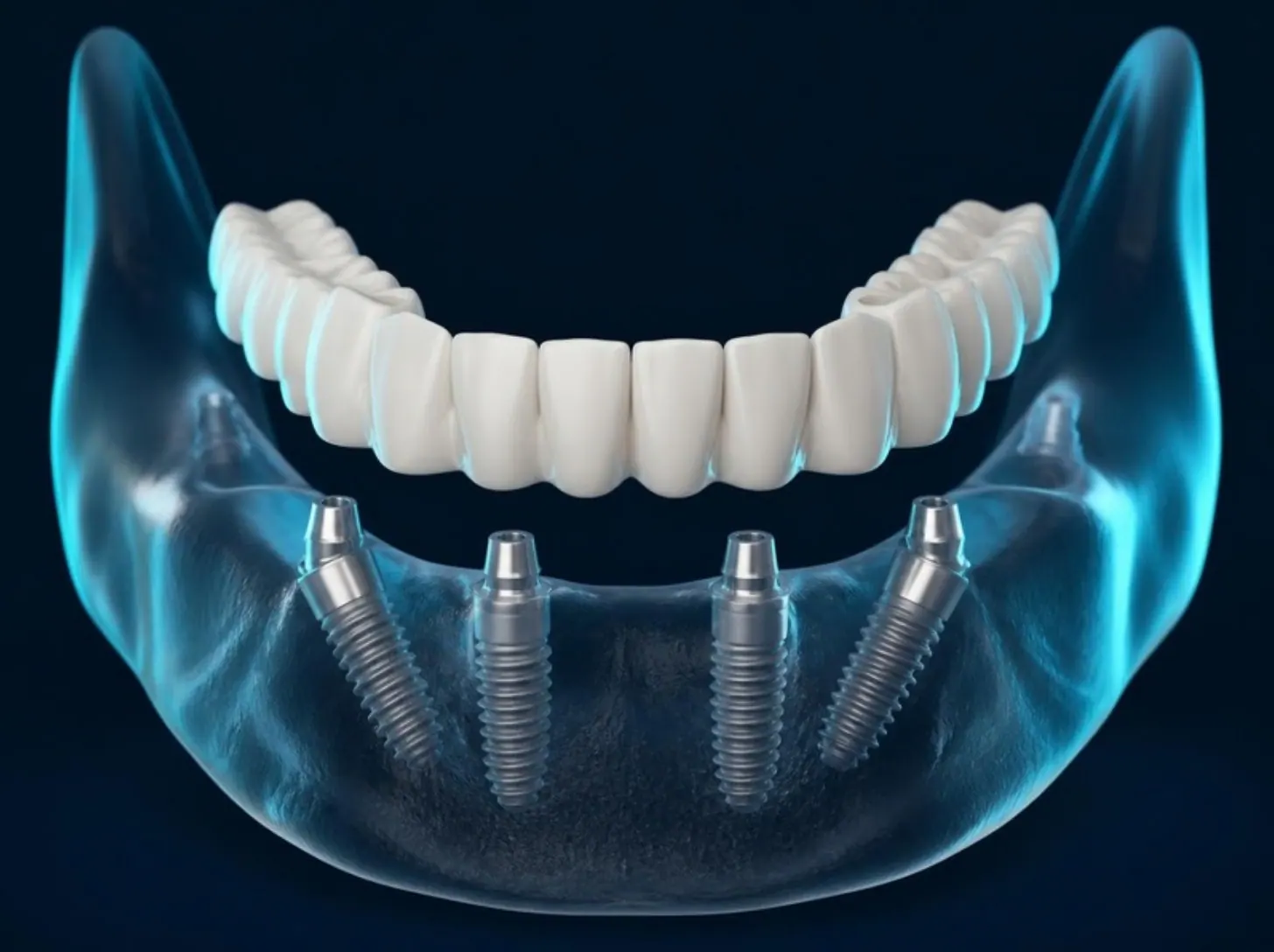 Dört implant üzerinde tam çene köprü (temsili görsel)
